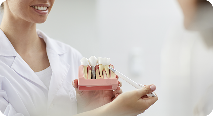 implantes dentales en Málaga cuidados